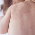 estado-de-sao-paulo-reforca-necessidade-de-vacinacao-contra-o-sarampo