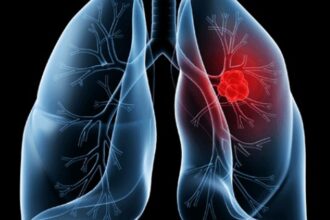 saiba-o-que-e-adenocarcinoma-pulmonar,-cancer-que-atinge-o-papa